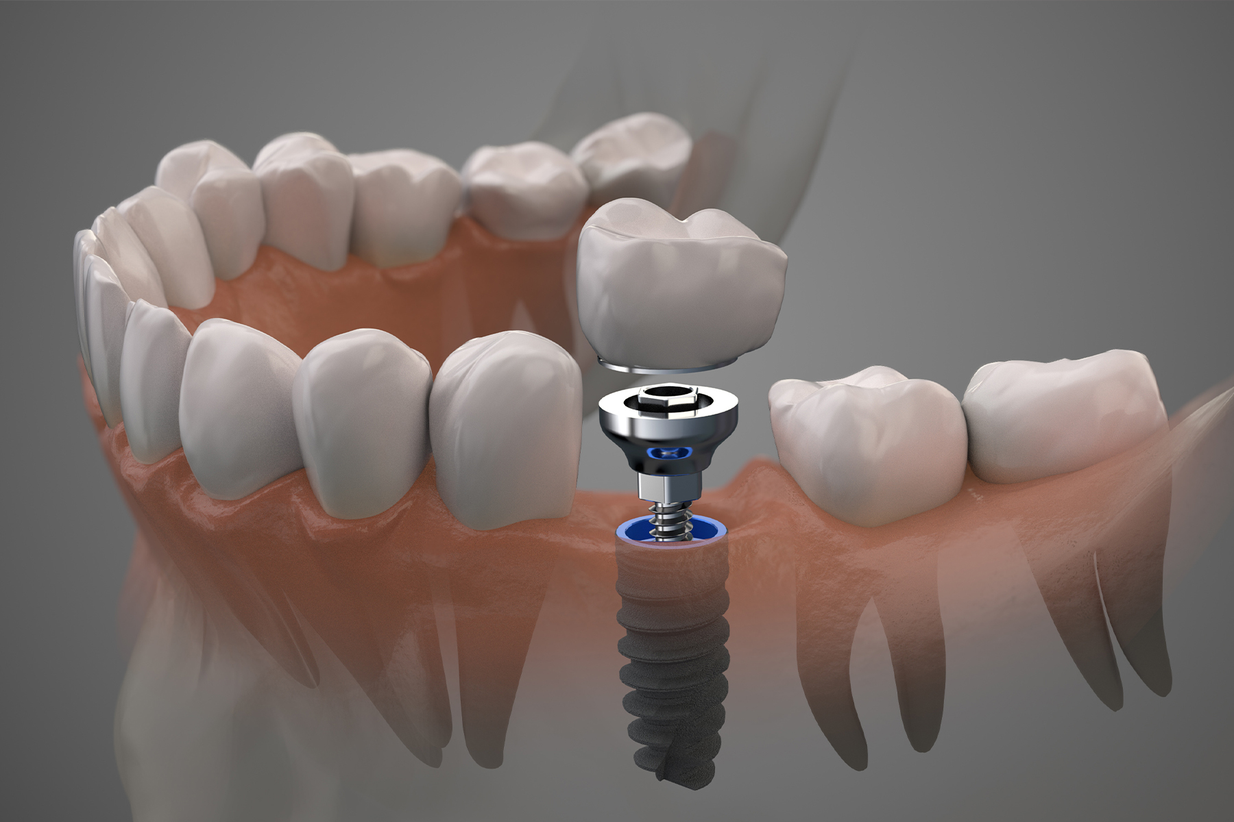 日本口腔インプラント学会とは？ | 南柏駅20秒の歯医者｜柏市南柏中央